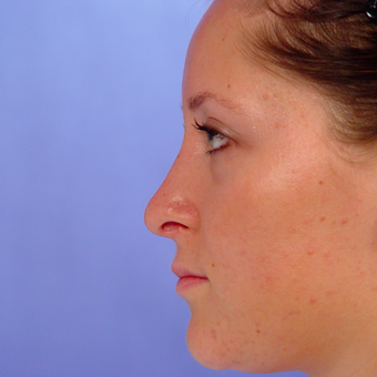 18-24 year old woman treated with Rhinoplasty after 3570323