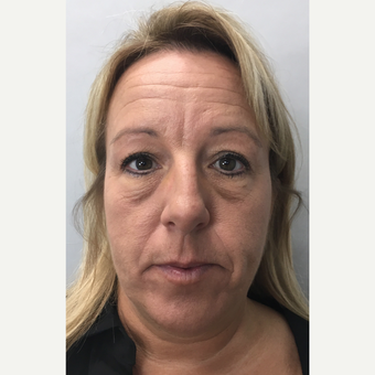 35-44 year old woman treated with Dysport before 3802723