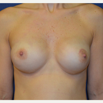 35-44 year old woman treated with Breast Reconstruction after 3140042