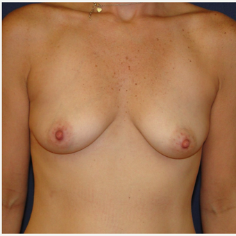 35-44 year old woman treated with Breast Reconstruction before 3140042