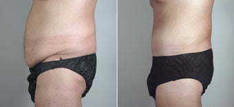 25 Year Old Male Seeking Tummy Tuck after 720780