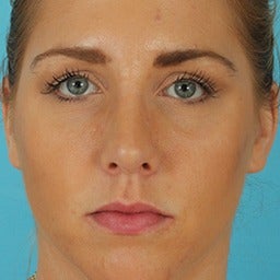 Rhinoplasty after 1675615