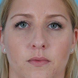 Rhinoplasty before 1675615