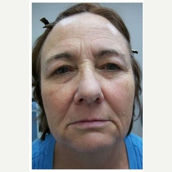 57 year old woman treated with InMode Fractora to the face and neck before 1983055