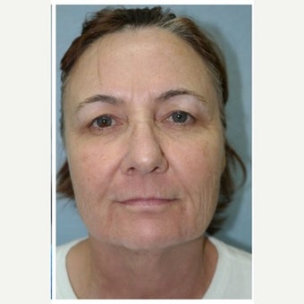 57 year old woman treated with InMode Fractora to the face and neck after 1983055