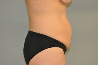 25-34 year old woman treated with Drainless Tummy Tuck 3129621