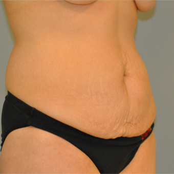 25-34 year old woman treated with Drainless Tummy Tuck before 3129621