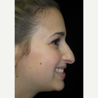 Scarless Closed Rhinoplasty before 3586269