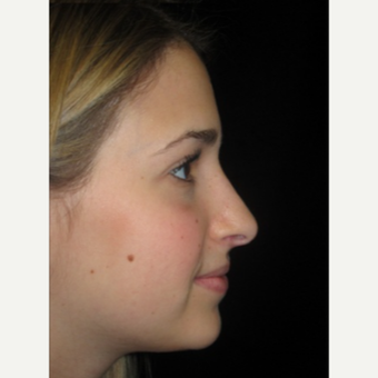 Scarless Closed Rhinoplasty after 3586269