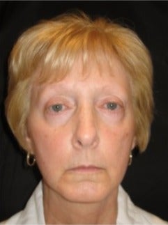 55-64 year old woman treated with Non Surgical Face Lift before 3181332