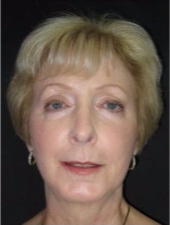 55-64 year old woman treated with Non Surgical Face Lift after 3181332