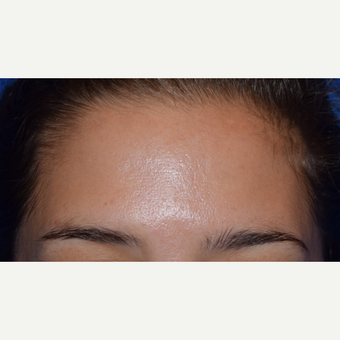25-34 year old woman with forehead lines treated with Botox after 3642159