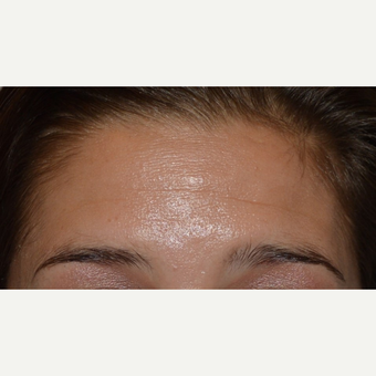 25-34 year old woman with forehead lines treated with Botox before 3642159