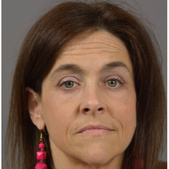 45-54 year old woman treated with Eyelid Surgery after 3411461