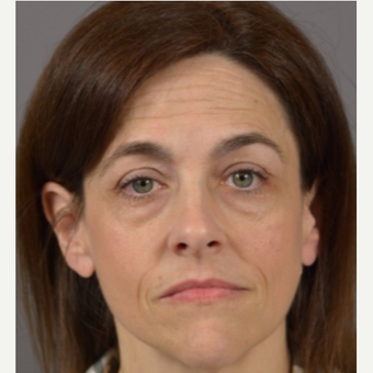 45-54 year old woman treated with Eyelid Surgery before 3411461