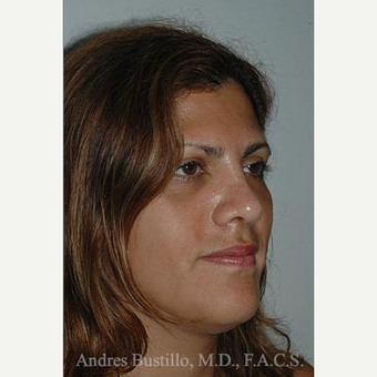 27 year old woman treated with Rhinoplasty after 3462388