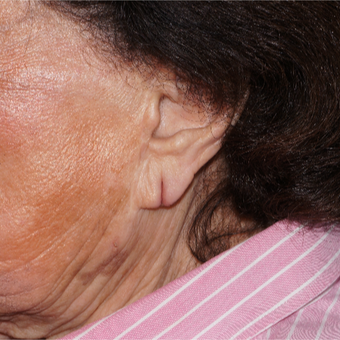 Patient with torn ear lobe from heavy earrings getting pulled, immediate result before 3365993