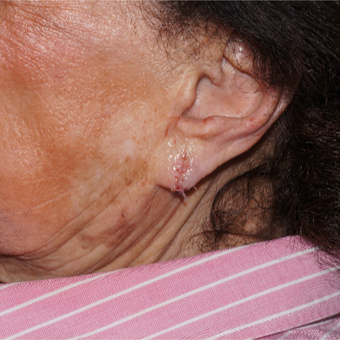 Patient with torn ear lobe from heavy earrings getting pulled, immediate result after 3365993
