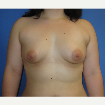 18-24 year old woman treated with Breast Implants (360cc) before 3262612