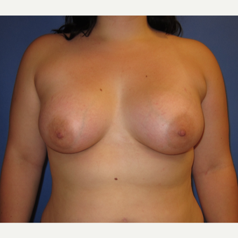 18-24 year old woman treated with Breast Implants (360cc) after 3262612