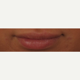 25-34 year old woman treated with Voluma for Lip Augmentation after 3494120