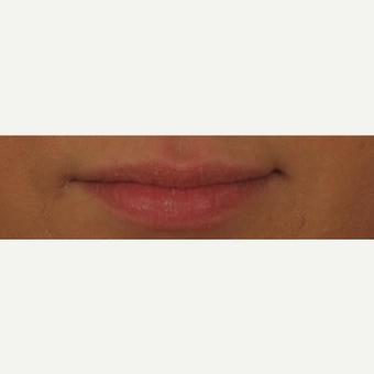 25-34 year old woman treated with Voluma for Lip Augmentation before 3494120