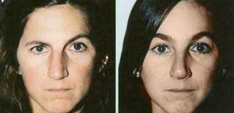 Female Treated for Unilateral Right Brow Ptosis before 1130484