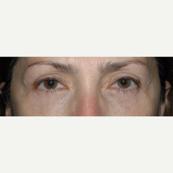 45 year old woman treated with Eyelid Surgery after 3710560