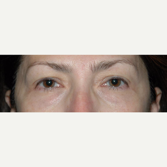 45 year old woman treated with Eyelid Surgery before 3710560
