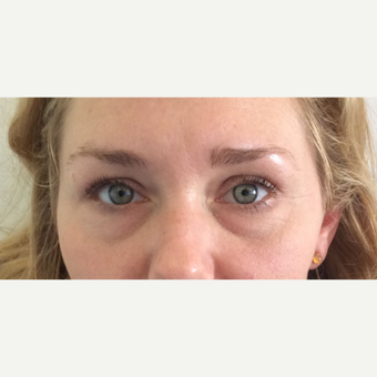 Juvederm Under Eye Filler (Tear Trough) Treatment before 3042518