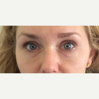 Juvederm Under Eye Filler (Tear Trough) Treatment after 3042518