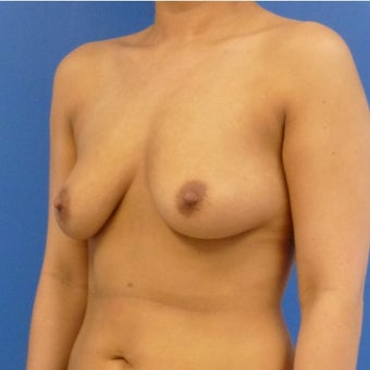 26 y.o. female – Breast Augmentation – 600cc High Profile Silicone Implants before 2420761