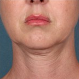 Kybella before 1853631