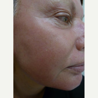 Medium depth laser peel after 2257767
