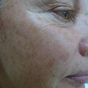 Medium depth laser peel before 2257767