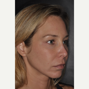 35-44 year old woman treated with Revision Rhinoplasty 2 weeks post-op before 3452226