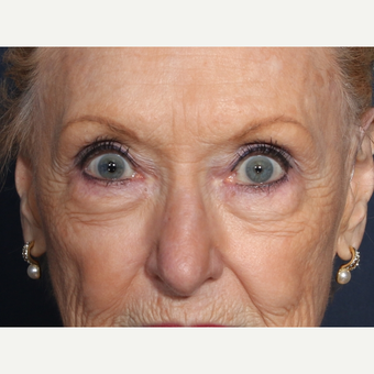 75 and up year old woman treated with Eyelid Surgery (view 1 of 2) before 3710612