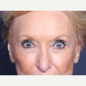 75 and up year old woman treated with Eyelid Surgery (view 1 of 2) after 3710612