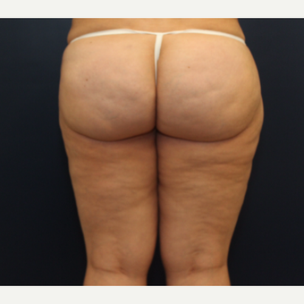 45-54 year old woman treated with Cellulaze before 3142564