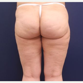 45-54 year old woman treated with Cellulaze after 3142564