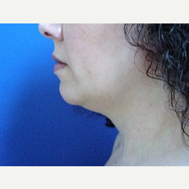 Neck Liposuction before 2989333