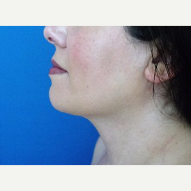 Neck Liposuction after 2989333