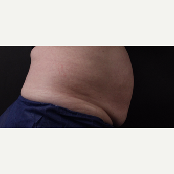 59 year old woman treated with CoolSculpting before 3384620