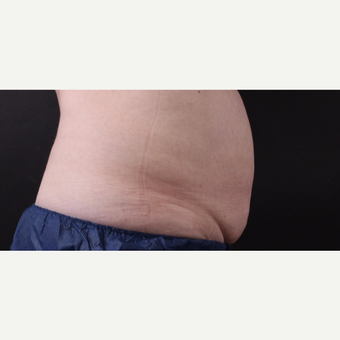 59 year old woman treated with CoolSculpting after 3384620