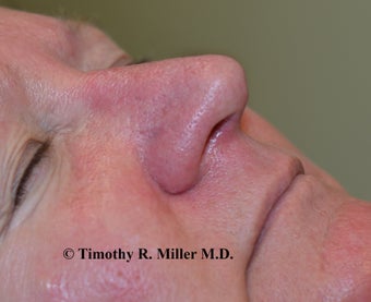 Nasal vessel elimination after 1449129