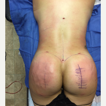 35-44 year old woman treated with Smart Lipo after 3286921