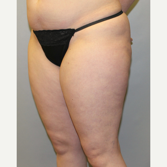35-44 year old woman treated with Liposuction after 3589597