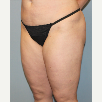 35-44 year old woman treated with Liposuction before 3589597