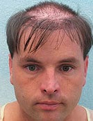 UGraft FUE-BHT hair transplantation using head and body hair before 195015