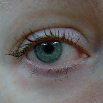 Laser and fillers- the perfect combination for wrinkle removal around the eyes. after 1812833